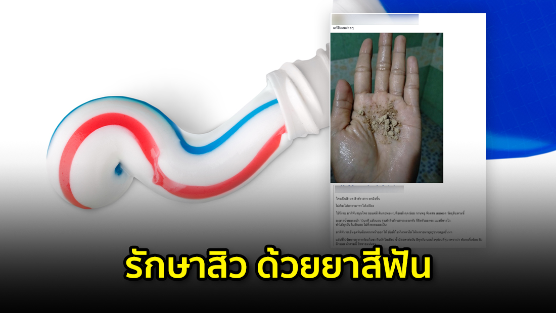 ข่าวปลอม อย่าแชร์! รักษาสิว ด้วยยาสีฟัน > ศูนย์ต่อต้านข่าวปลอม ประเทศไทย